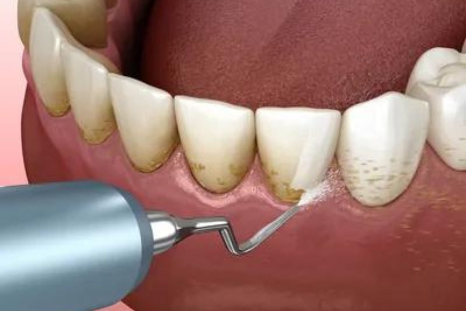 Dental Services- Scaling and Root Planing