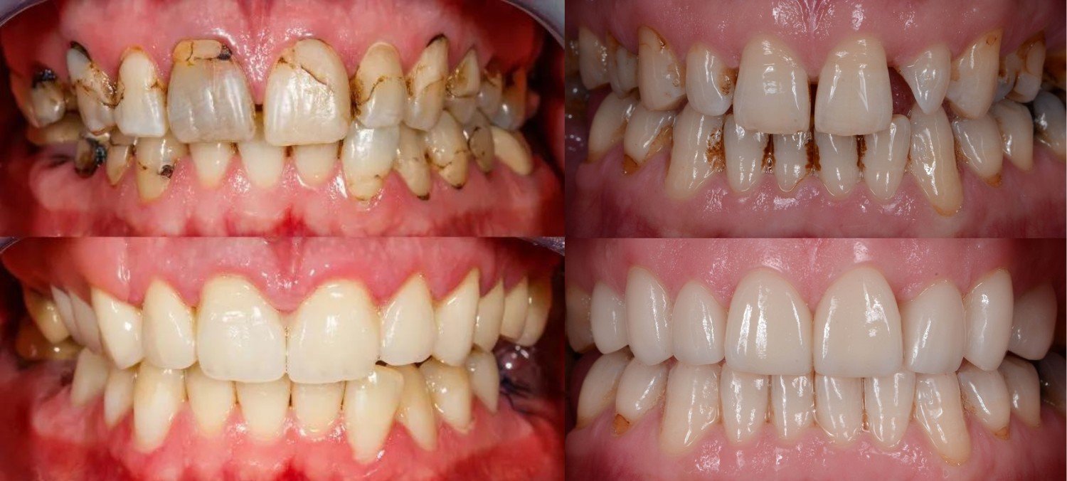 Dental Services- Full Mouth Rehabilitation