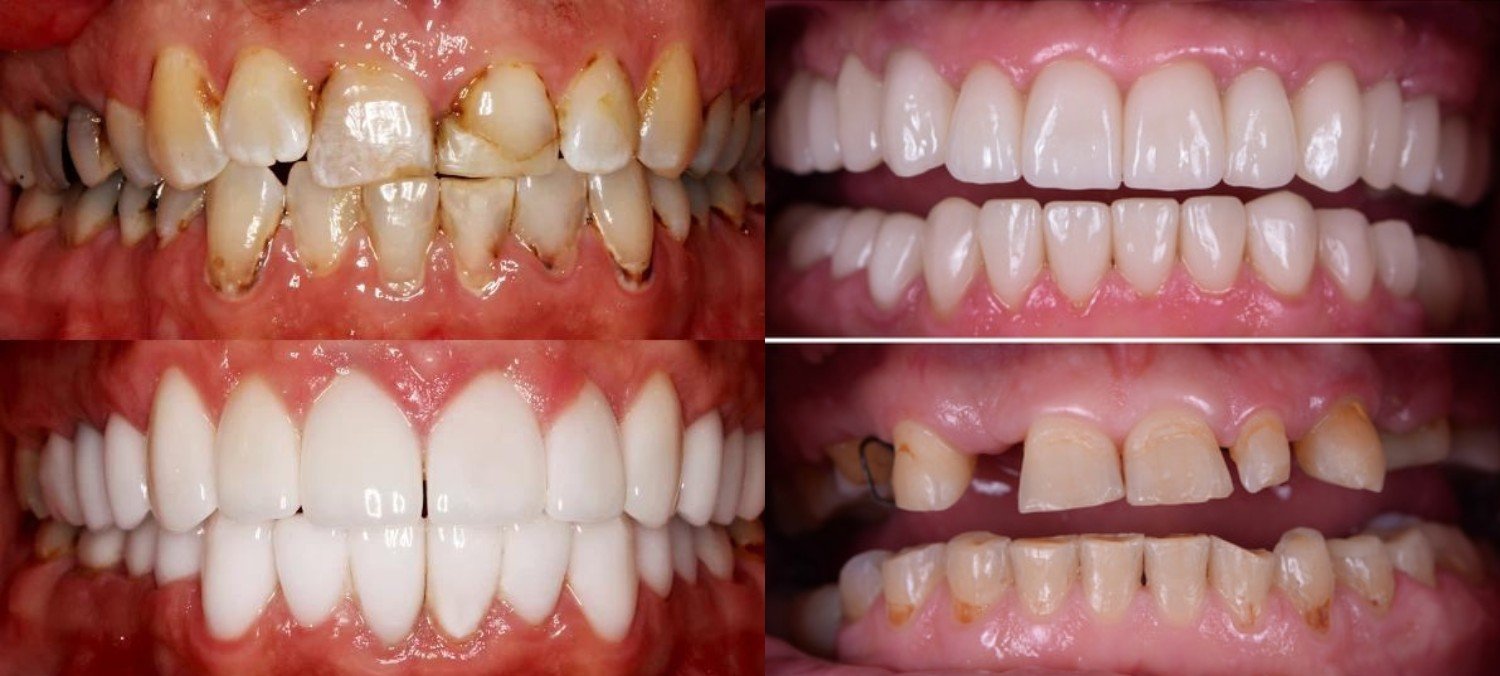 Dental Services- Full Mouth Rehabilitation