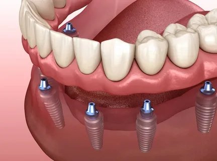 Dental Services- Implant Supported Dentures