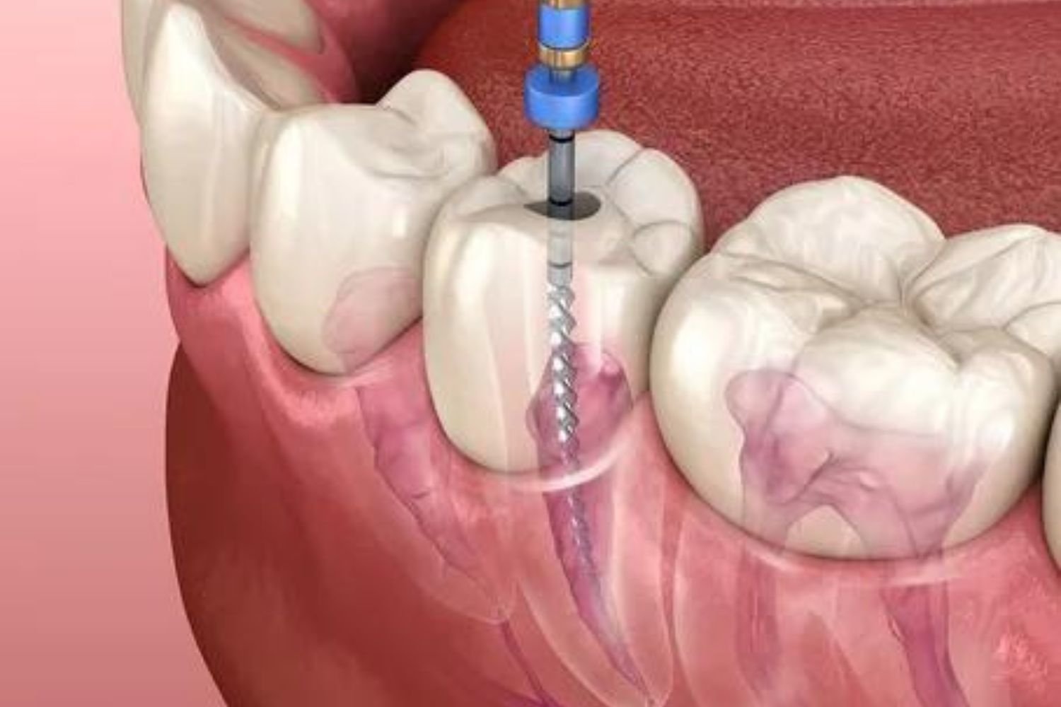 Dental Services- Root Canal Treatment