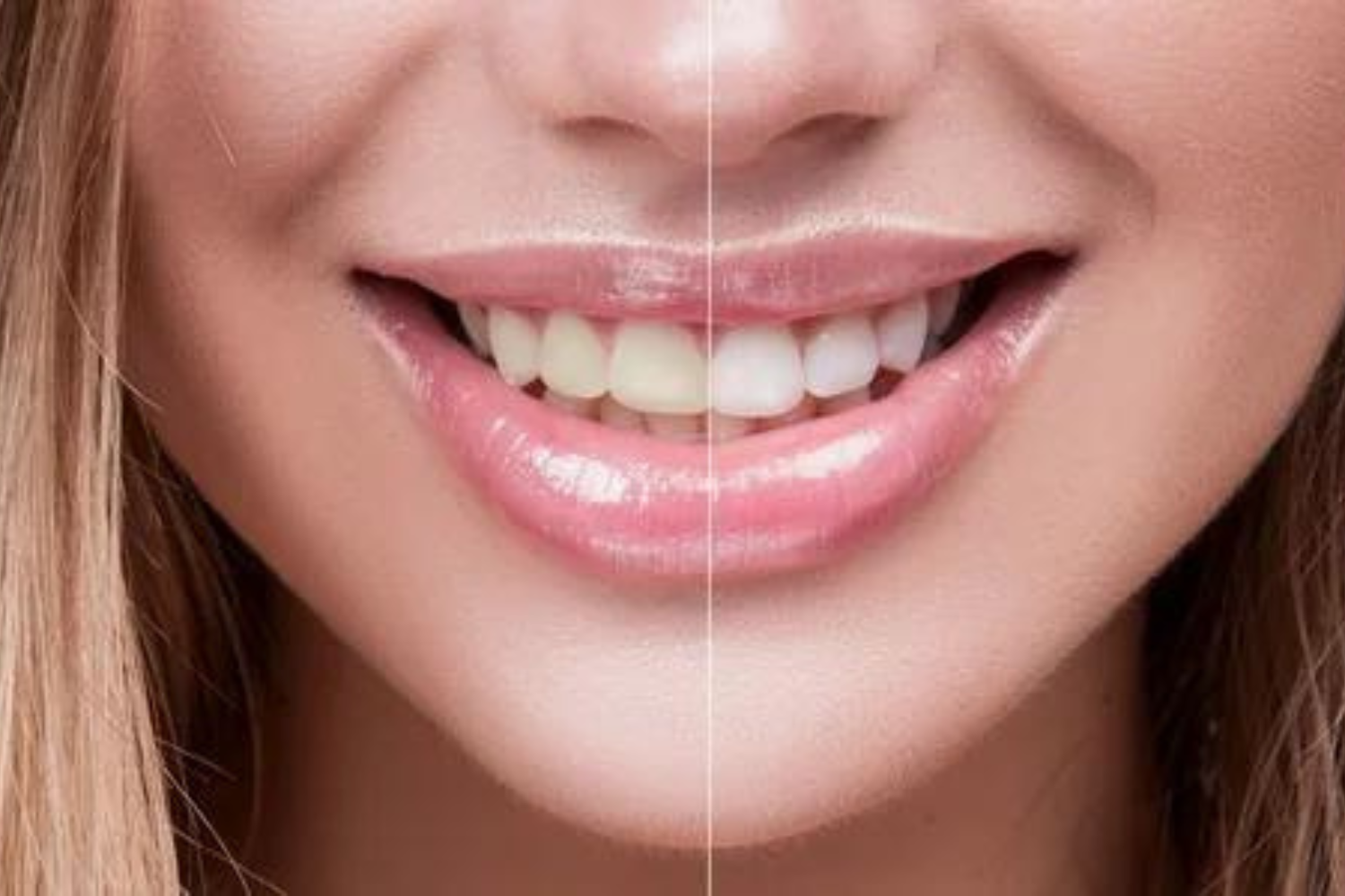 Smile Makeover