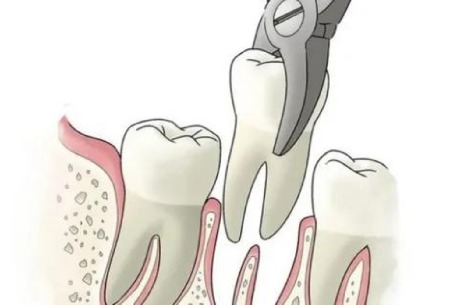 Dental Services- Tooth Extraction